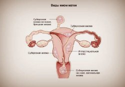Миома матки: причины, симптомы и методы лечения