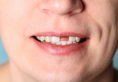 Основные причины расшатывания зубов. Шатаются зубы у взрослого — причины и лечение