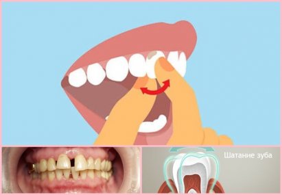 Основные причины расшатывания зубов. Шатаются зубы у взрослого — причины и лечение