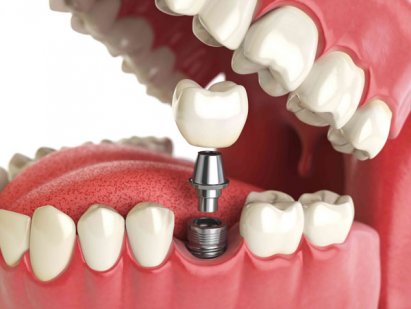 Какие бывают виды протезирования зубов?