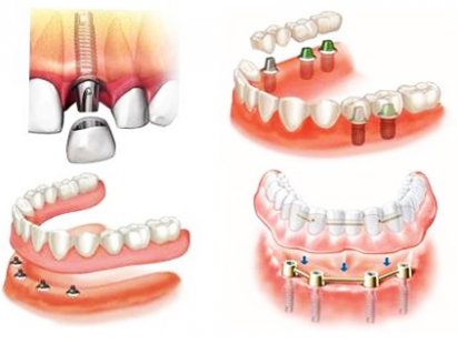 Какие бывают виды протезирования зубов?