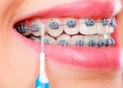 Установка брекетов зубных