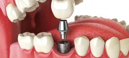 Сколько стоит поставить зубной имплант?