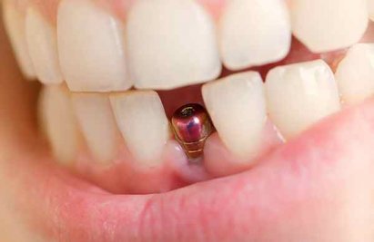 Сколько стоит поставить зубной имплант?