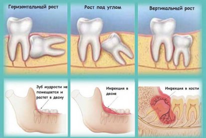 Протезирование и стоматология - Удаление зуба мудрости