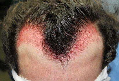 Пересадка волос – безопасный способ при выпадении волос, залысинах, алопеции. Инновационные технологии