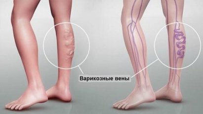 Лечение варикоза в Москве