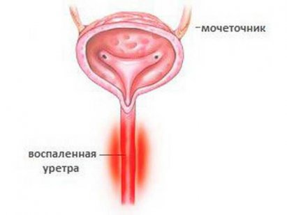 Уретрит у женщин - симптомы и лечение