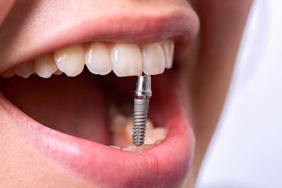 Почему необходимо восстановление зубов?