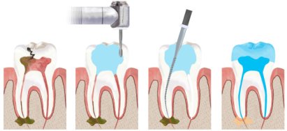 Качественное лечение зубов. Съемные протезы на передние зубы