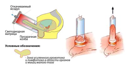 Как проводится лечение эректильной дисфункции