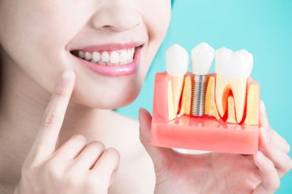 Имплантация зубов: особенности и преимущества метода All-on 4