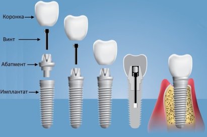 Имплантация зуба в Калининграде