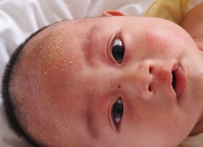 Себорейный дерматит у детей: причины, симптомы и лечение