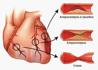 Как лечится стенокардия: методы и подходы к управлению сердечной болью