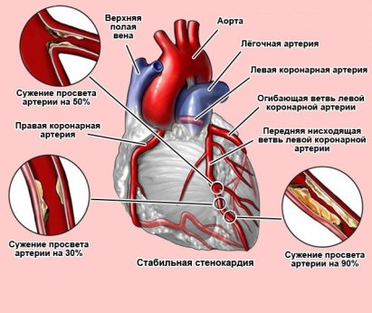 Как лечится стенокардия: методы и подходы к управлению сердечной болью