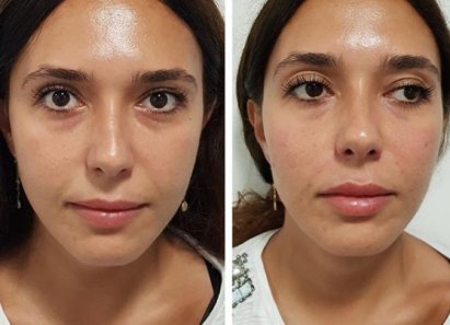 Enhancing Facial Volume with Cheek Fillers
