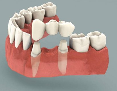 Съемные зубные протезы: Возвращение к улыбке и нормальной жизни