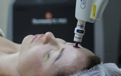 Лазерная шлифовка кожи лица: особенности и эффективность процедуры