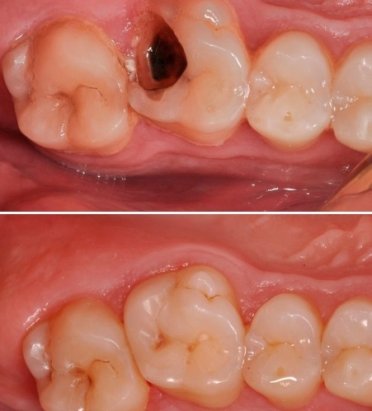 Лечение Кариеса: Современные Методы и Забота о Зубах