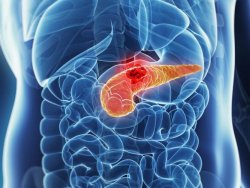 Рак підшлункової залози та алкоголь: причини та симптоми