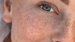 Пігментація більше не вирок: як освітлити шкіру без пілінгів та лазера