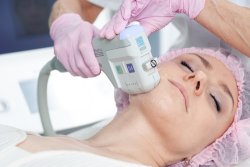 В чем секрет SMAS-лифтинга: откуда берется эффект подтяжки?