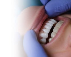 Композитные виниры, разрушая мифы