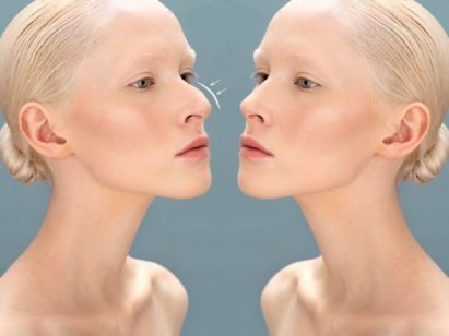 Хочу ринопластику